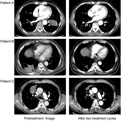 Neoadjuvant camrelizumab and chemotherapy in patients with resectable stage IIIA squamous non-small-cell lung cancer: Clinical experience of three cases